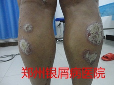郑州牛皮癣医院治疗牛皮癣图片