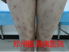 郑州牛皮癣医院治疗牛皮癣图片
